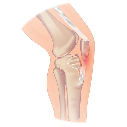 example knee