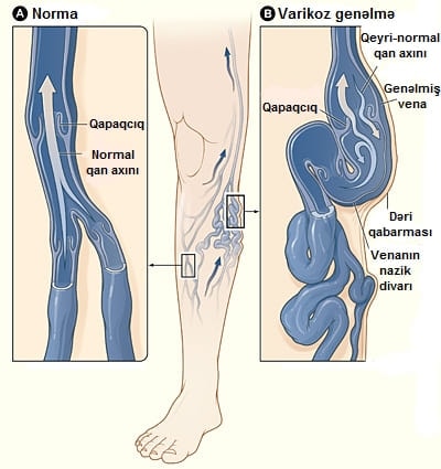 what is varicose